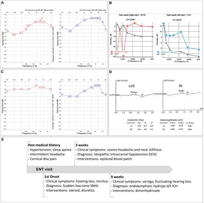 A hidden pathophysiology of endolymphatic hydrops: case report of a patient with spontaneous intracranial hypotension presenting with sudden sensorineural hearing loss with vertigo